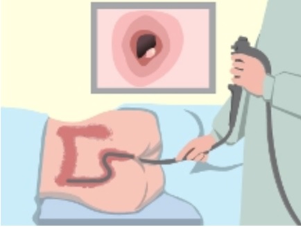 乙狀結腸鏡檢查