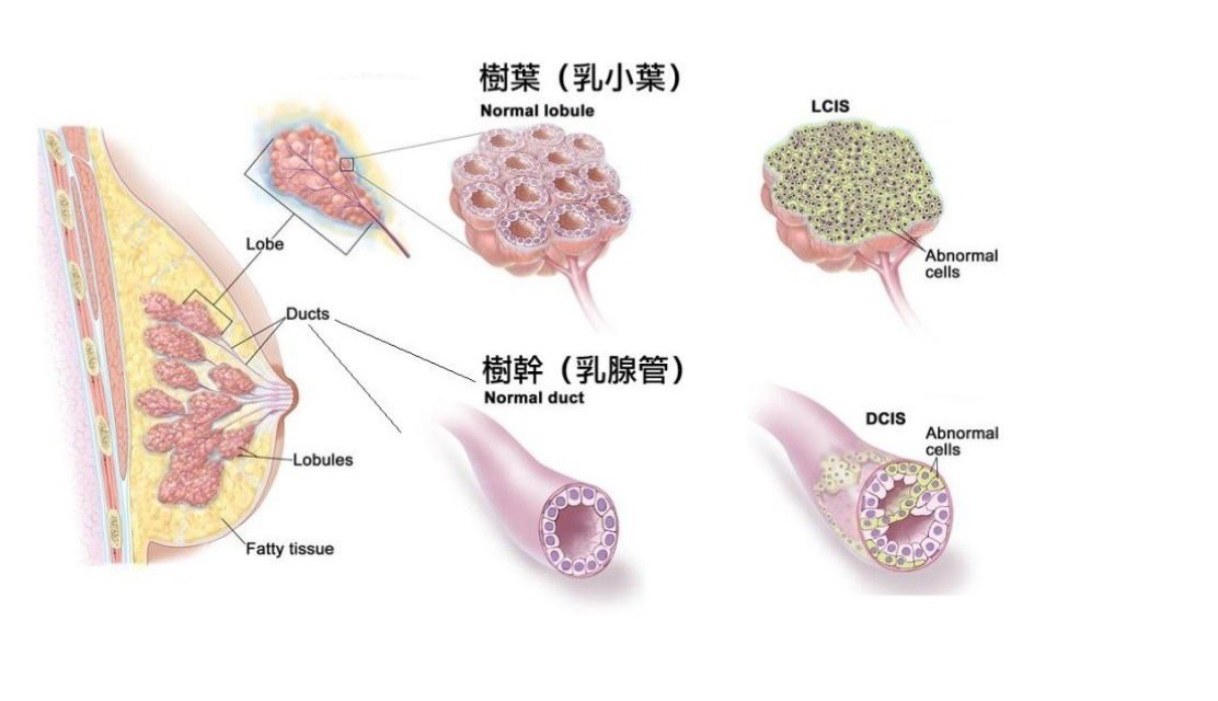 原位癌如何定義？】治療方法、保險理賠須知全攻略！  Bowtie