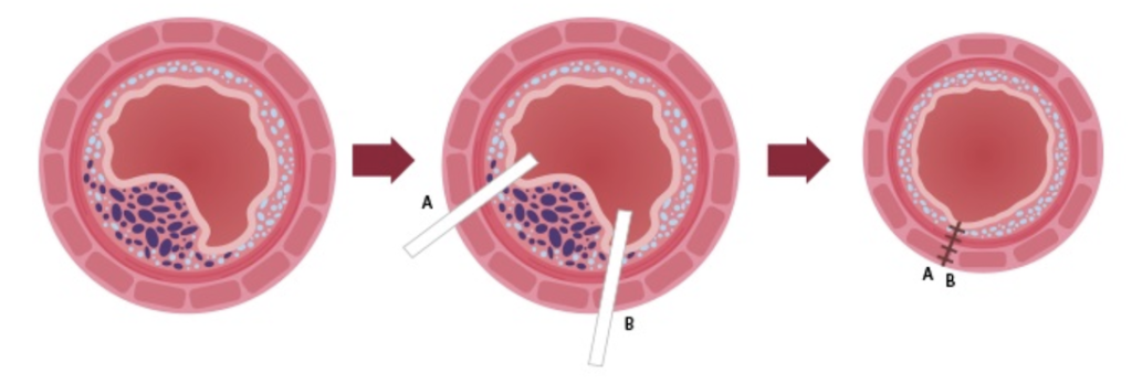 傳統痔瘡切除術