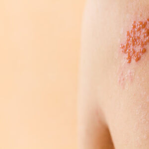 【生蛇】會傳染嗎？症狀會分階段？​成因、後遺症、高危人士及治療方法