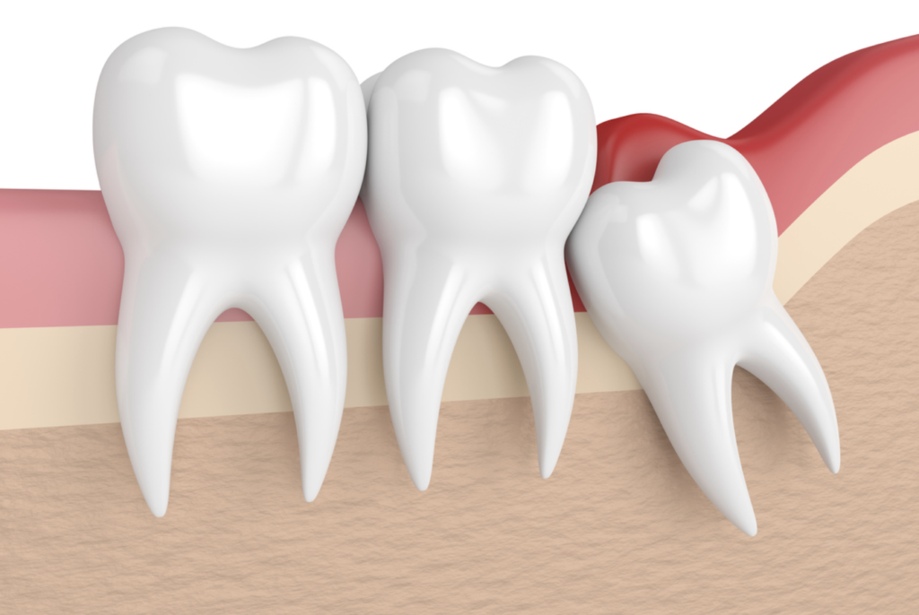 智慧齒斜生、賴生、發炎