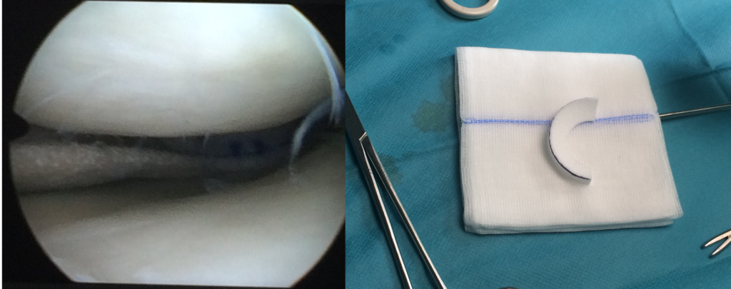 人工半月板假體