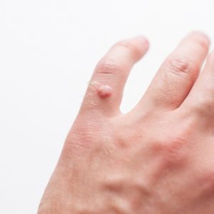 為何會生疣？了解脫疣方法、價錢及醫療保險的相關保障