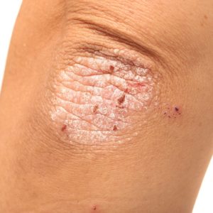 【牛皮癬】又稱銀屑病？可導致關節炎和頭皮？一文了解成因、護理和治療方法