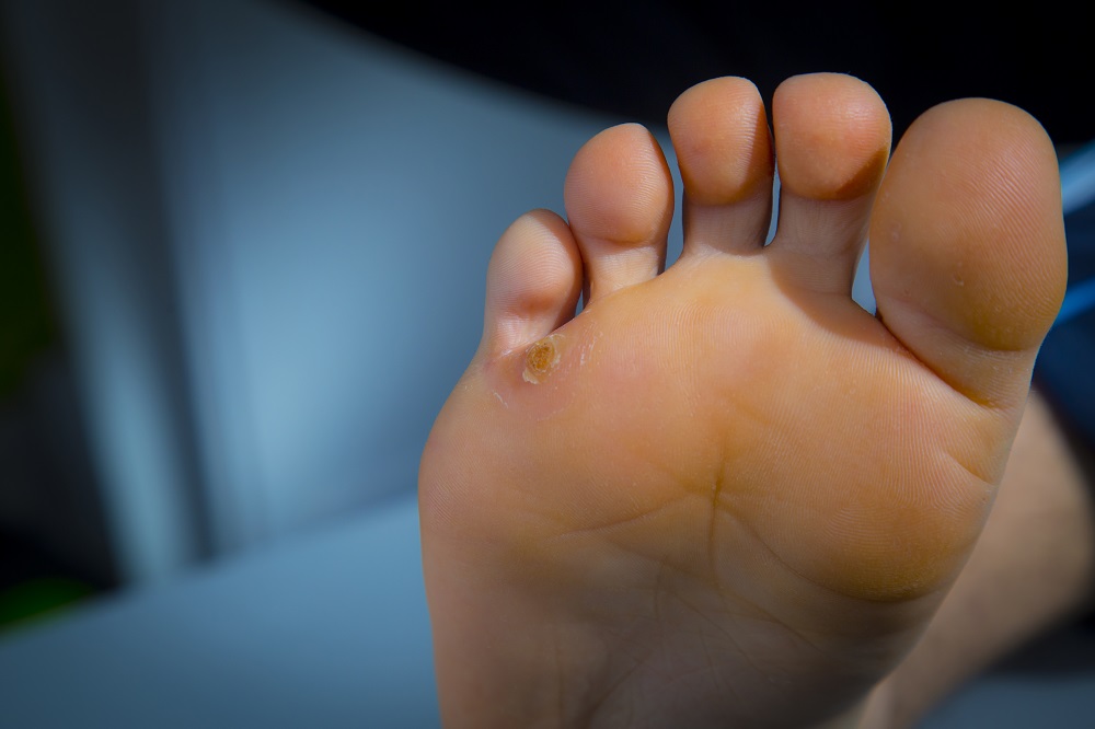 雞眼疼痛難醫好? 一文睇清成因、處理及預防方法