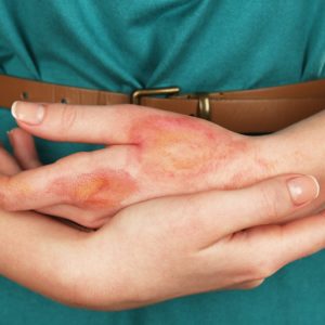 【燙傷】可以塗凡士林? 即睇正確處理程序