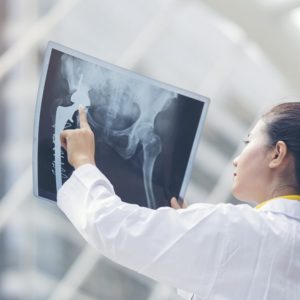 【骨癌】了解症狀、類型、診斷及治療方法