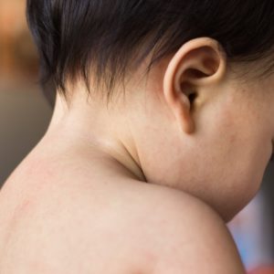 【玫瑰疹】是嬰兒常見疾病？了解成因、疾狀及治療方法！