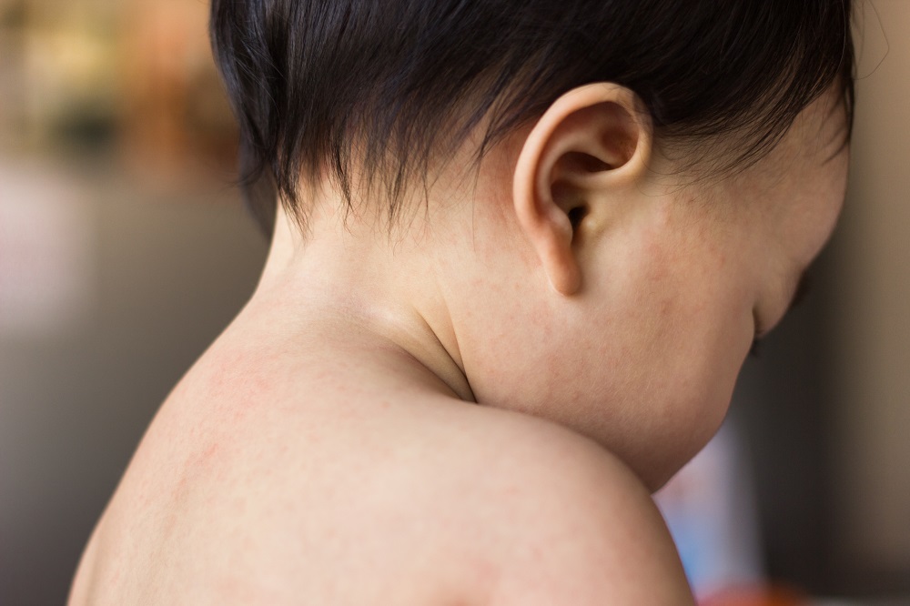【玫瑰疹】是嬰兒常見疾病？了解成因、疾狀及治療方法！
