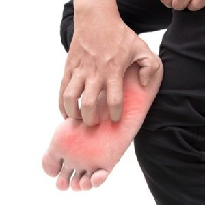 【香港腳】搽藥膏有無用？腳癬成因、症狀是有哪些？