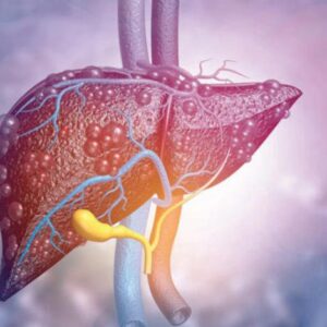 【肝硬化】存活期有多久？成因有哪些？詳解不同期數的症狀和治療方法