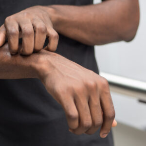 【風癩】要戒口嗎？中醫教你食療及急救止痕法！