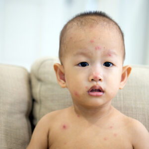 【水痘】多久會好? 了解治療、預防及重要注意事項