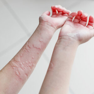 【蕁麻疹】出疹有何原因？搽藥膏有用？會傳染嗎？