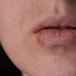 【疱疹】如何傳染？一文看清一、二型 HSV 的成因、病徵及治療方法