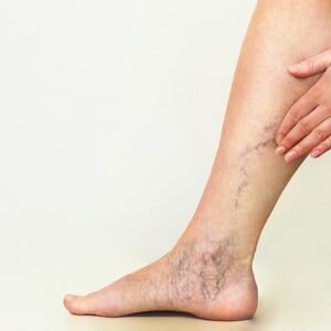 【靜脈曲張手術】費用、後遺症、類型比較及術後護理（附保險理賠貼士）