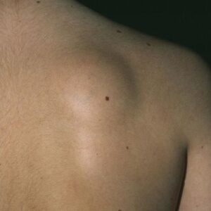 【脂肪瘤手術費用】比較醫院/ 診所費用，醫療保險賠多少?