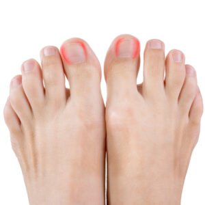 【嵌甲/倒甲】比較手術收費＋了解醫療保險賠不賠