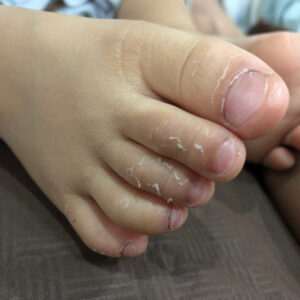 【川崎症】康復後可以打疫苗嗎？了解症狀、原因及後遺症！