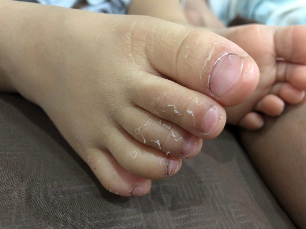 【川崎症】康復後可以打疫苗嗎？了解症狀、原因及後遺症！