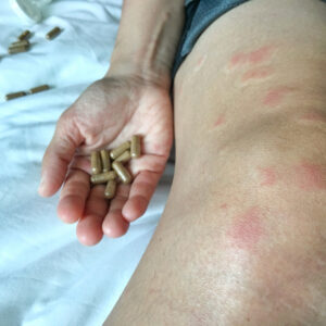 【紅斑狼瘡】認識症狀、成因、診斷、治療方法及飲食注意事項