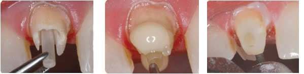 牙柱放置了於根管中以增加承托力