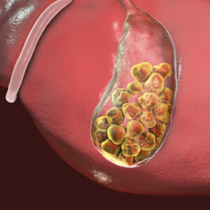 【生膽石】腹痛是症狀？身體可以自行排出嗎？