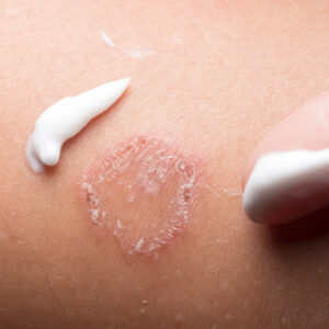 皮癬症狀似濕疹但成因大不同？治療要靠搽藥膏？