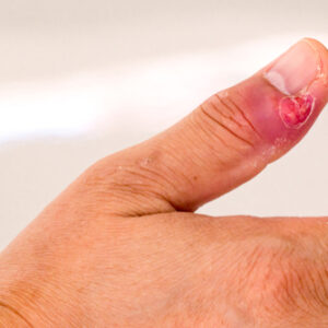 甲溝炎會自己好嗎？做手術幾錢？保險賠唔賠？