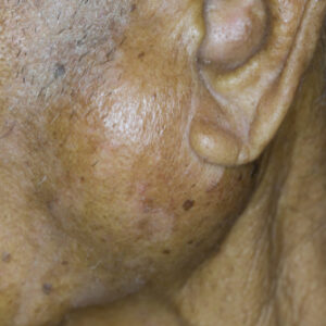 【腮腺瘤】會變為惡性嗎？手術費用多少？ 保險能保障嗎？