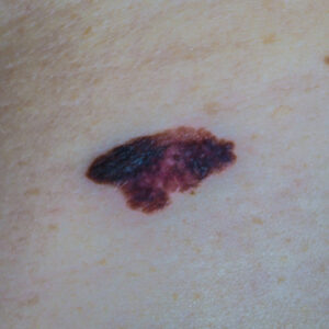 【黑色素瘤】等於皮膚癌？即睇診斷、治療方法及保險理賠