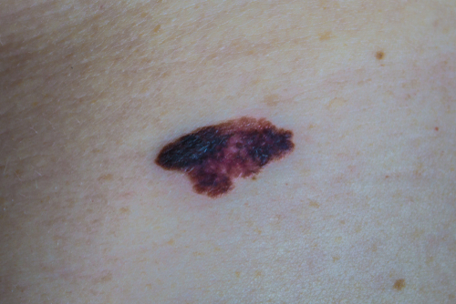 【黑色素瘤】等於皮膚癌？即睇診斷、治療方法及保險理賠