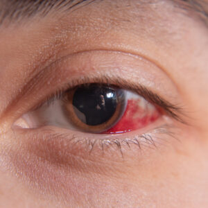 【眼角膜受損】即睇治療方法＋保險理賠