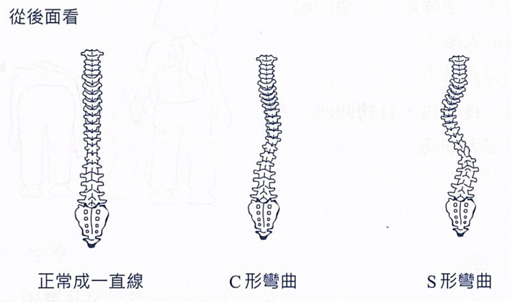 脊椎側彎