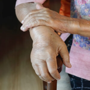 【水腫】原因及解決方法大全！常見腳腫、面腫可以咁處理