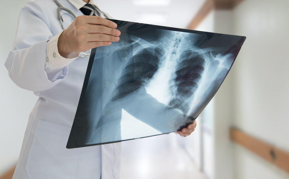 【照肺】全面了解肺部 X 光檢查價錢、程序及結果如何解讀！