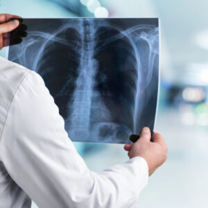 【肺部CT】可準確追蹤肺癌，即睇檢查費用及保險理賠！