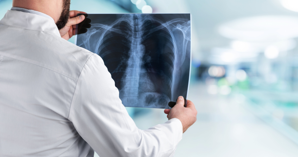 【肺部CT】可準確追蹤肺癌，即睇檢查費用及保險理賠！
