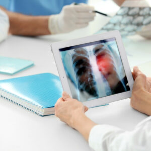 肺腺癌：存活率多高？前兆症狀明顯嗎？成因、分期及治療方法