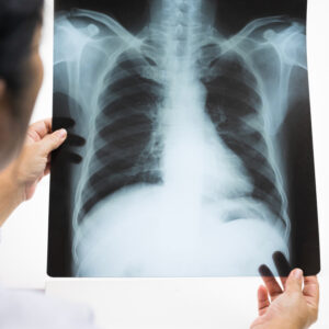 【肺腺癌治療】方法互補提升患者存活率！附收費及保險理賠資訊