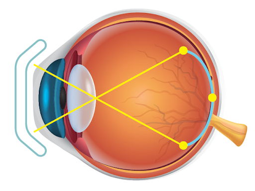 OK鏡控制近視的方法