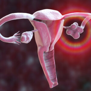 【多囊卵巢症】有 5 大警號！如何檢查及診斷？患者可能不孕？