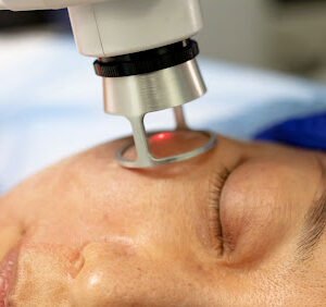 色斑越來越深，想一次K.O.？一文了解皮秒去斑療程究竟有幾勁？