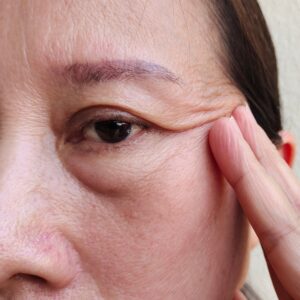 【眼瞼下垂】一文看清成因、影響及手術治療方法！