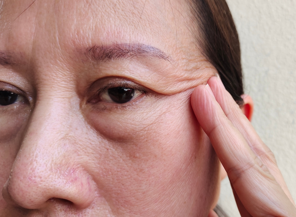 【眼瞼下垂】一文看清成因、影響及手術治療方法！