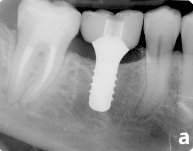 植牙一般頸部比原來真牙窄
