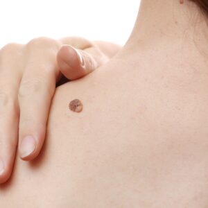 【脫疣VS藥膏】比較不同方法的原理、過程及術後注意事項