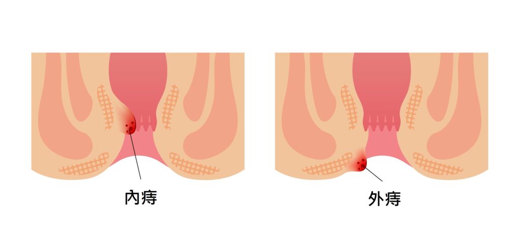 痔瘡種類