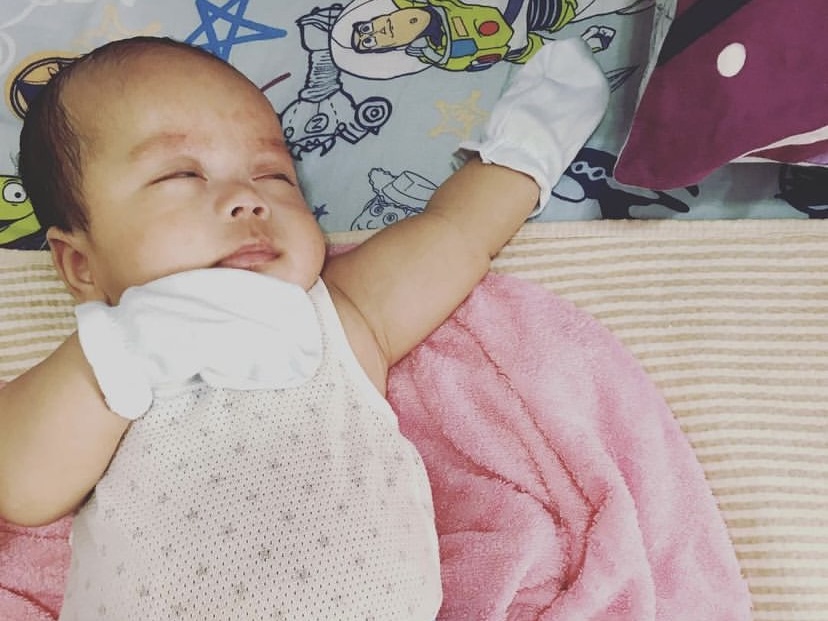 先天性病童患有罕見病「第十條染色體缺失」