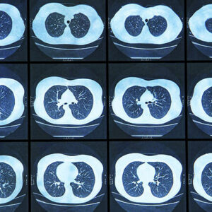 【肺部CT】認識詳細步驟！進行前後要注意甚麼？